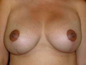 breast augmentation with lift patient