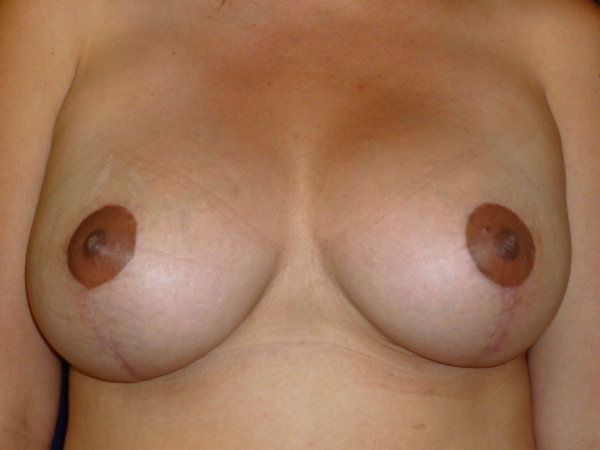 breast augmentation with lift patient
