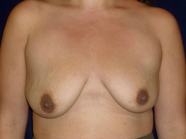 breast augmentation with lift patient