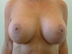 breast augmentation with lift patient