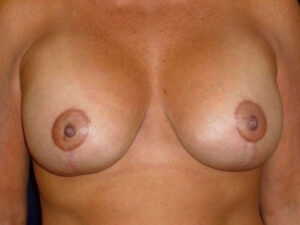 breast augmentation with lift patient
