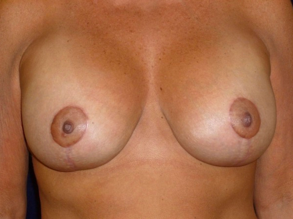 breast augmentation with lift patient