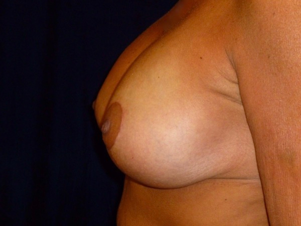 breast augmentation with lift patient