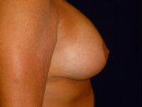 breast augmentation with lift patient