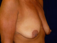 breast augmentation with lift patient