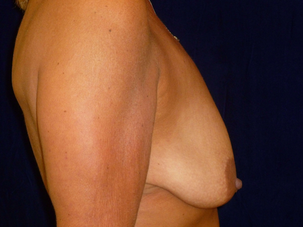 breast augmentation with lift patient