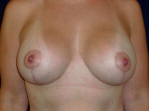 breast augmentation with lift patient