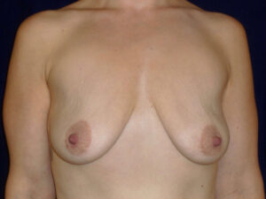 breast augmentation with lift patient