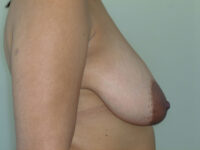breast lift patient