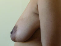 breast lift patient