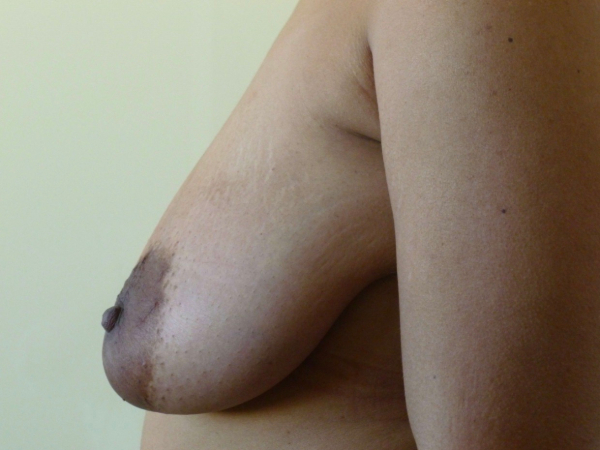 breast lift patient