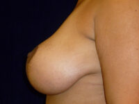 breast lift patient