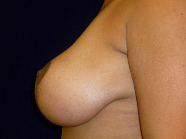 breast lift patient