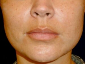 dermal fillers patient