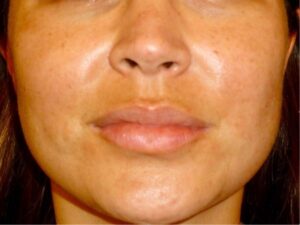 dermal fillers patient