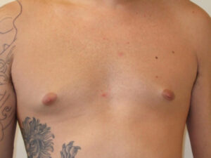 gynecomastia patient