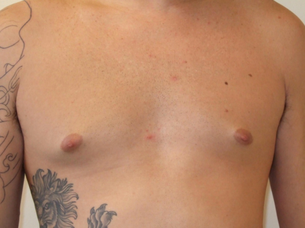 gynecomastia patient