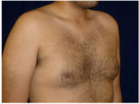gynecomastia patient