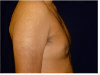 gynecomastia patient