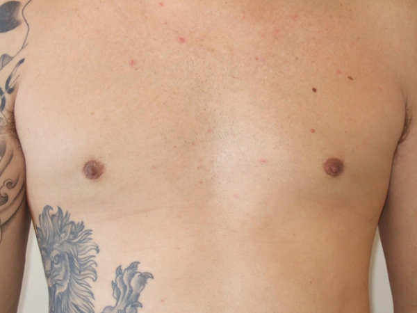 gynecomastia patient