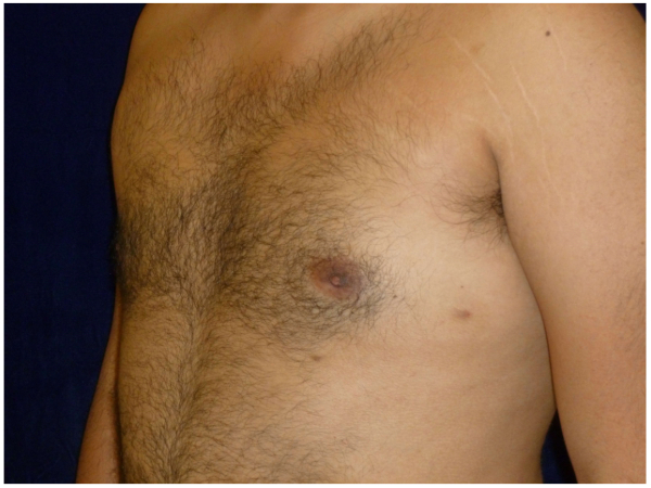 gynecomastia patient