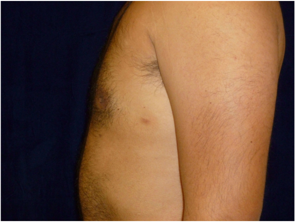 gynecomastia patient