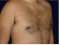 gynecomastia patient
