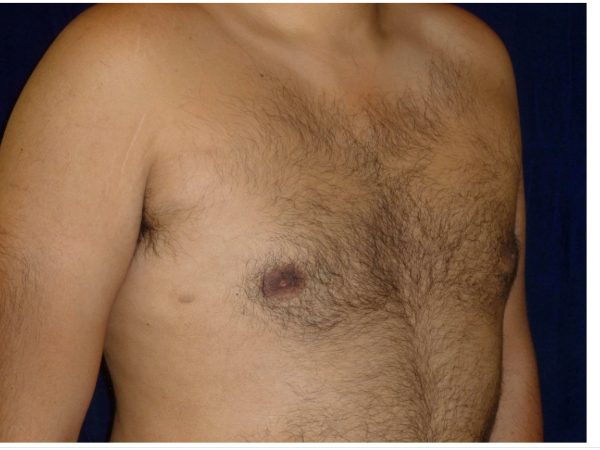 gynecomastia patient