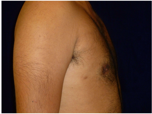 gynecomastia patient