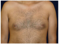gynecomastia patient