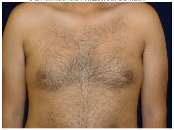 gynecomastia patient