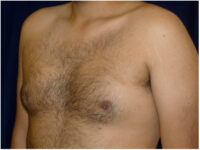 gynecomastia patient