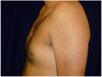 gynecomastia patient
