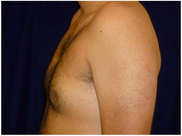 gynecomastia patient