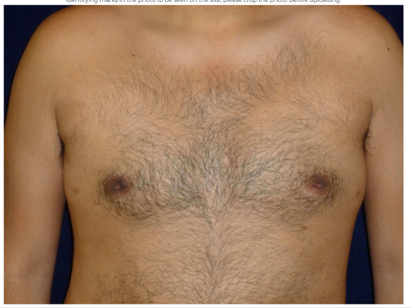 gynecomastia patient