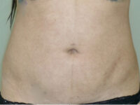 Liposuction patient