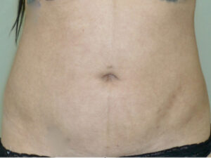 Liposuction patient