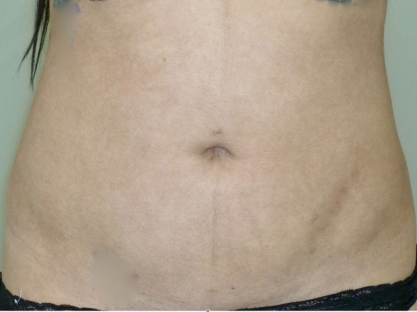 Liposuction patient