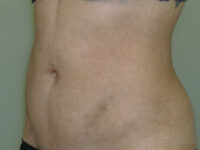 Liposuction patient