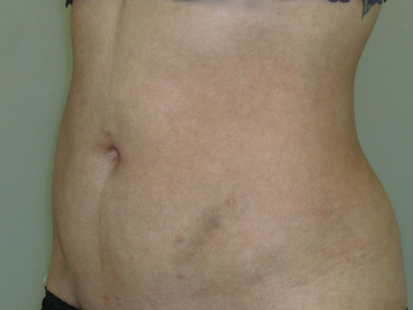 Liposuction patient