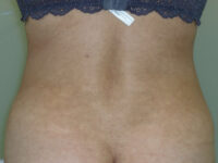 Liposuction patient