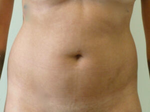 Liposuction patient