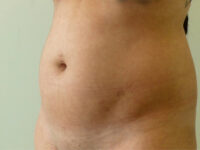 Liposuction patient