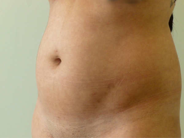 Liposuction patient