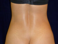 Liposuction patient