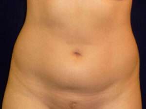 Liposuction patient