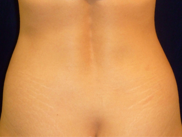 Liposuction patient
