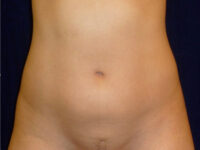 Liposuction patient