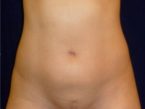 Liposuction patient