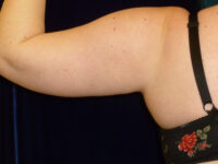 Liposuction patient